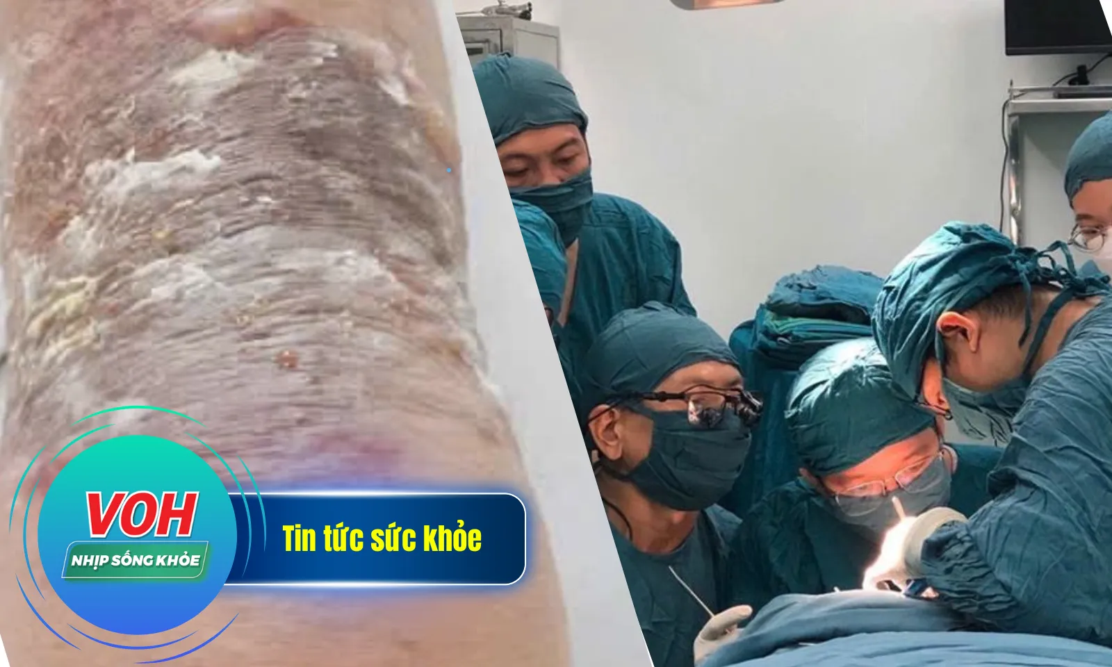 Nhịp Sống Khỏe 11/1: Bôi dầu nóng chữa gãy xương, bị nhiễm trùng | Bé 4 ngày tuổi bị teo thực quản