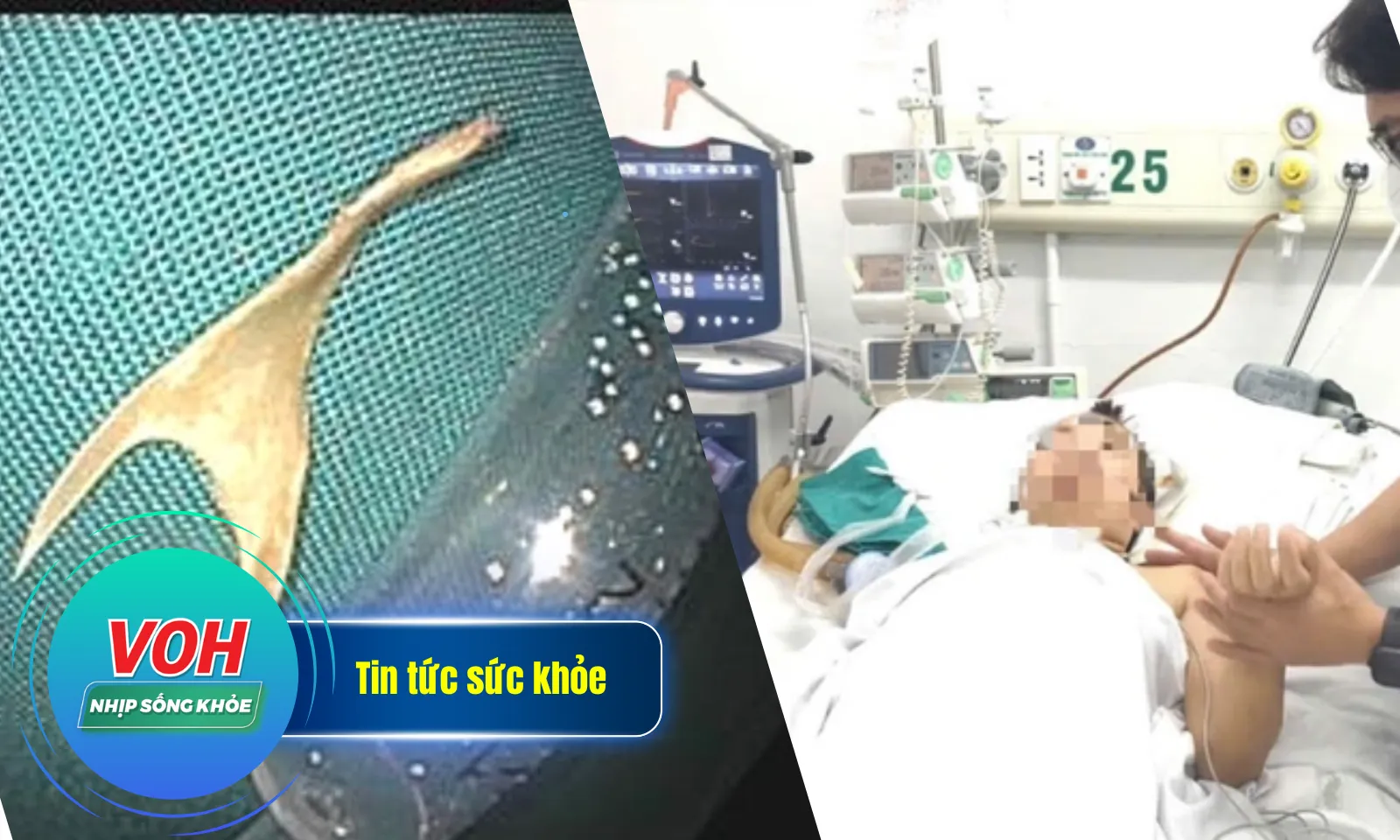 Nhịp Sống Khỏe 14/1: Ăn cháo bị hóc xương hình chạc ba| Liệt toàn thân sau mũi tiêm trị đau vai gáy