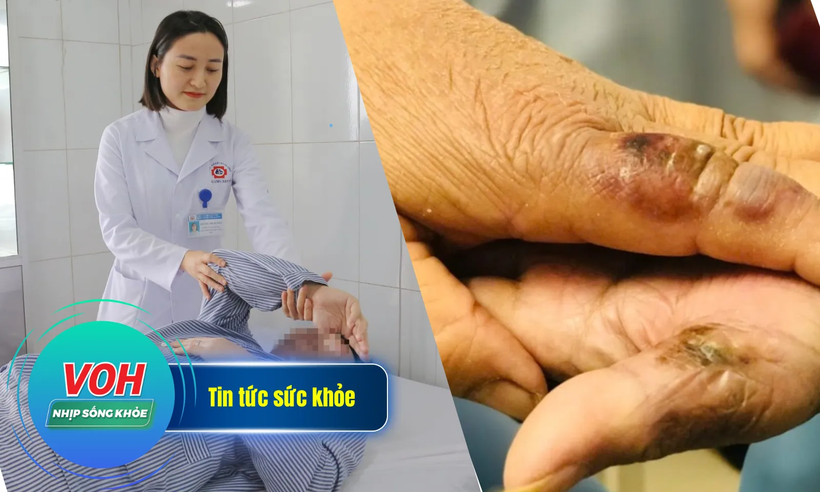 Nhịp Sống Khỏe 15/1: Bị đứt gân cơ khi chơi pickleball | Hai vợ chồng nguy kịch do bị chuột cắn