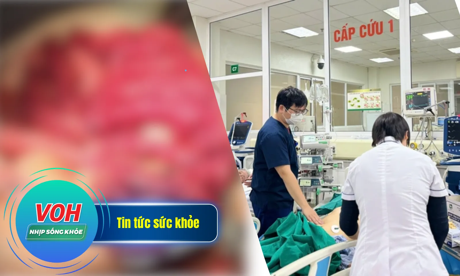 Nhịp Sống Khỏe 16/1: Bị cắt 3m ruột do xuất huyết tiêu hóa | Nhiều ca viêm phổi nặng nhập viện