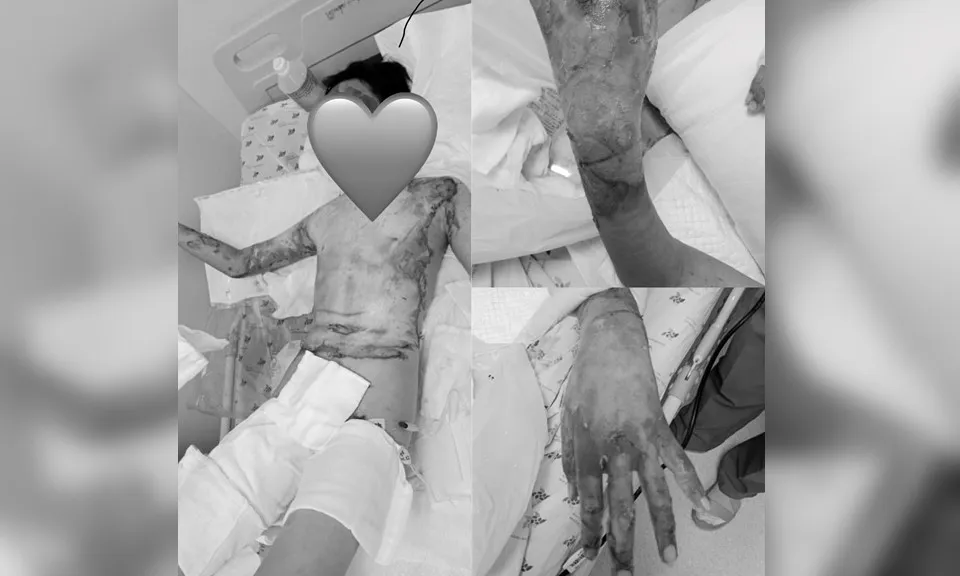 Bé trai bỏng nặng do đốt cồn với lúa làm cốm nổ