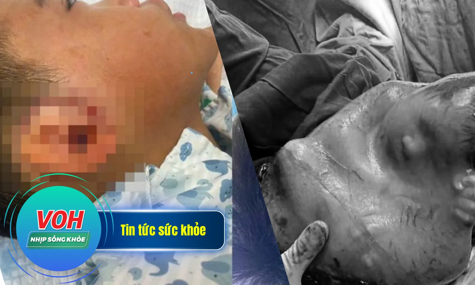 Nhịp Sống Khỏe 5/2: Bé trai 8 tuổi suýt mất tai vì chó cắn | Bé trai đẻ bọc điều hiếm gặp
