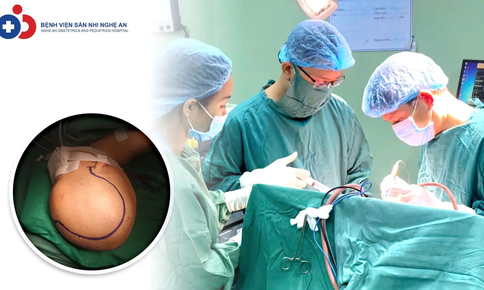 Cứu sống em bé gần 2 tuổi chấn thương sọ não nặng do ngã cầu thang từ độ cao 2m