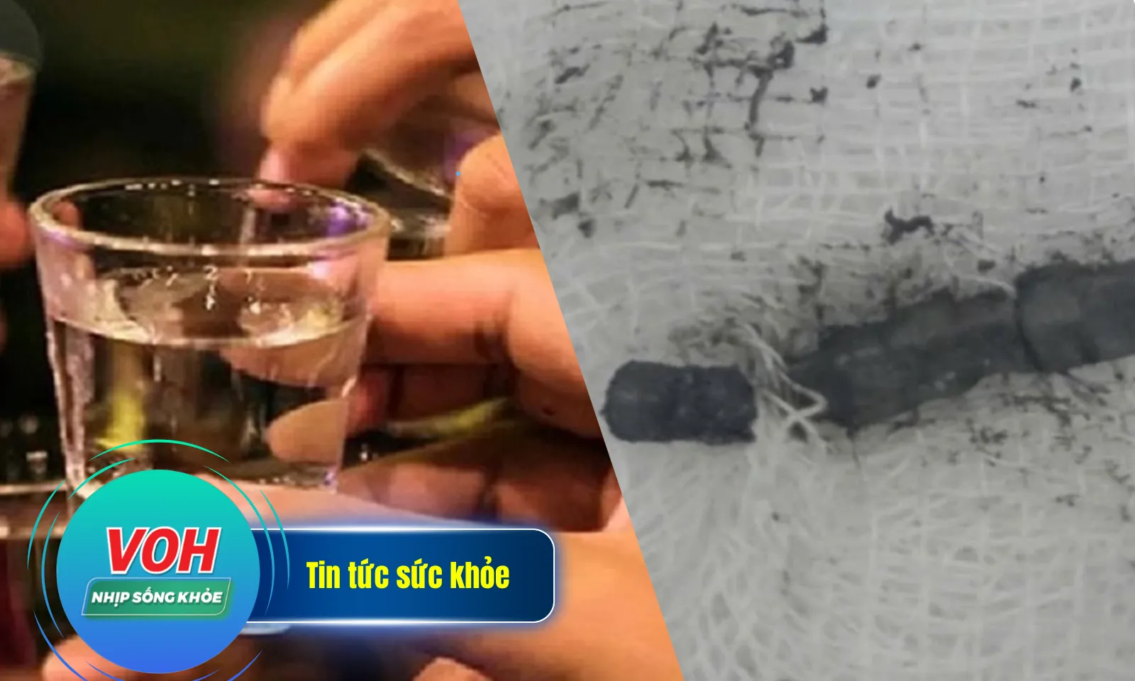 Nhịp Sống Khỏe 13/2: Hôn mê nguy kịch vì nhậu suốt Tết | Bé gái 2 tuổi nuốt 27 viên nam châm