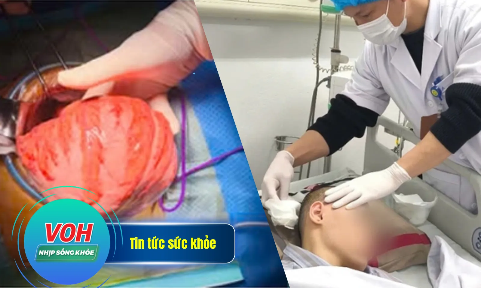 Nhịp Sống Khỏe 18/2: Chửa phân do bệnh bẩm sinh |Giãn não thất do di chứng lao màng não 