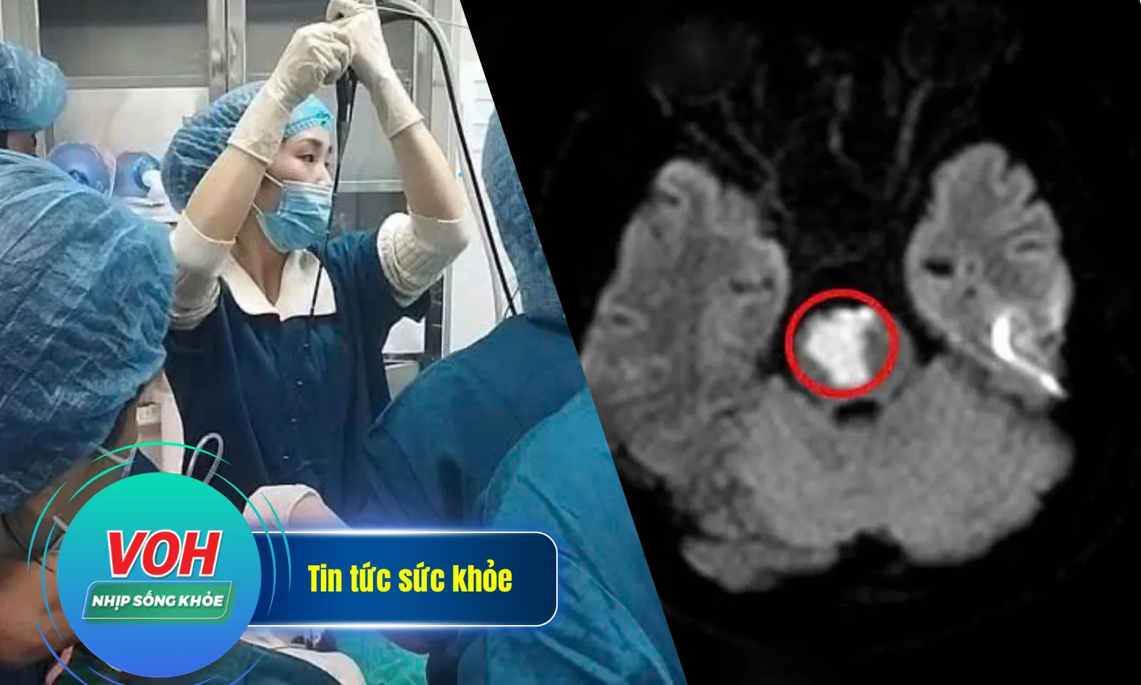 Nhịp Sống Khỏe 21/2: Cứu cháu bé nuốt phải xương khi ăn cháo | thanh niên 17 tuổi bị nhồi máu não