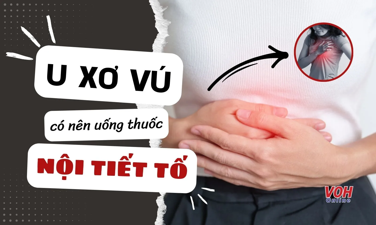 Bị u xơ tuyến vú có nên uống thuốc nội tiết tố?