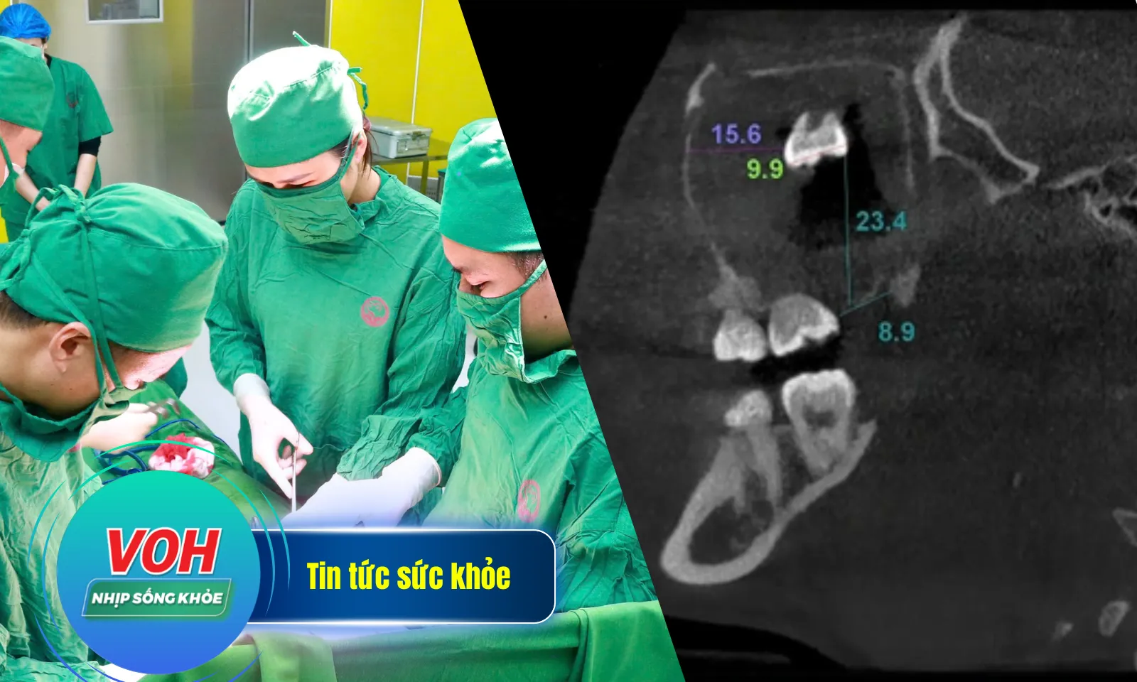 Nhịp Sống Khỏe 6/3: Cứu sống sản phụ thai ngoài tử cung góc sừng | Răng khôn lạc trong xoang hàm 