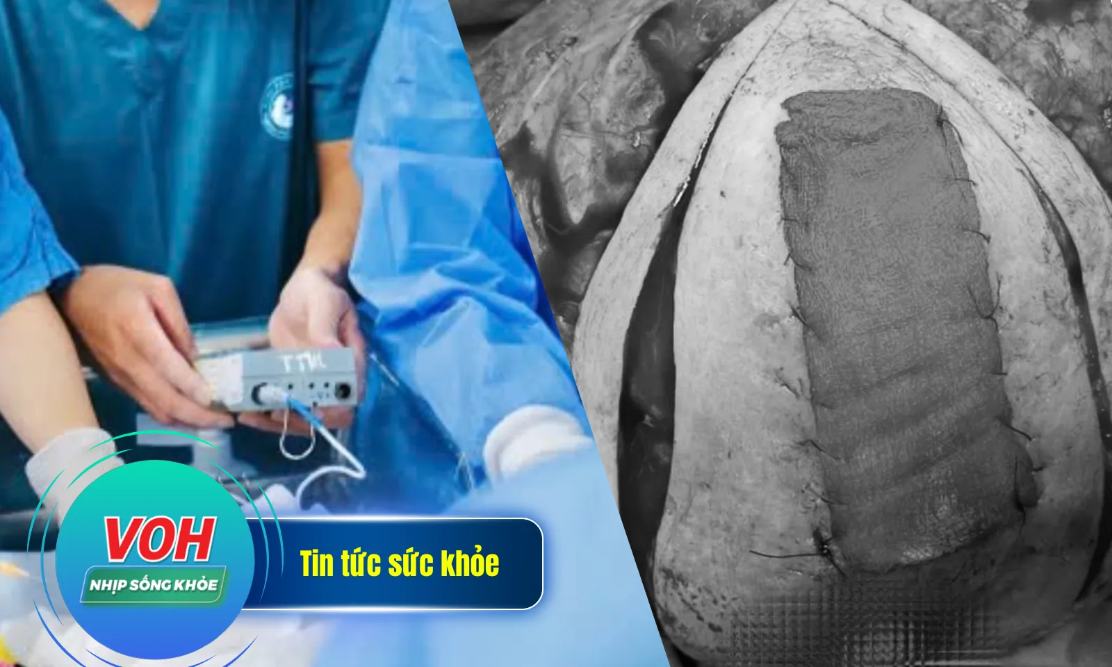 Nhịp Sống Khỏe 08/03: Mang khối u vú khủng hơn 3kg do chủ quan | Can thiệp tim xuyên bào thai  