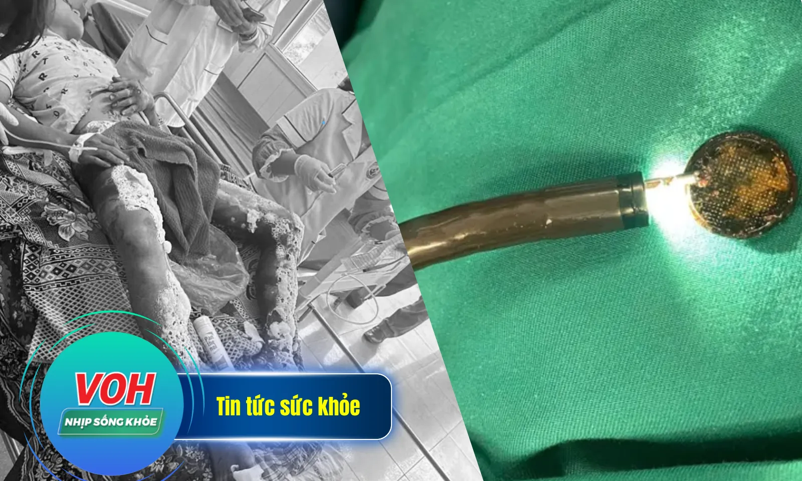 Nhịp Sống Khỏe 12/03: bỏng nặng vùng kín do điện thoại phát nổ | Lấy pin cúc áo kẹt trong thực quản