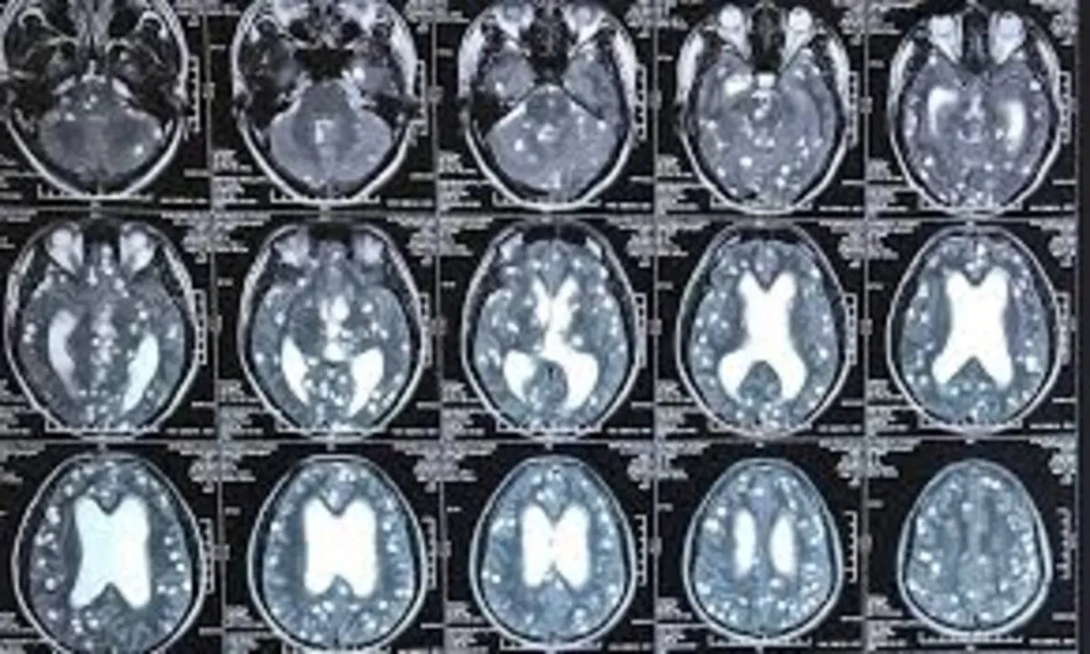 Rối loạn tâm thần do sán não: Nguy cơ tiềm ẩn và cách phòng ngừa