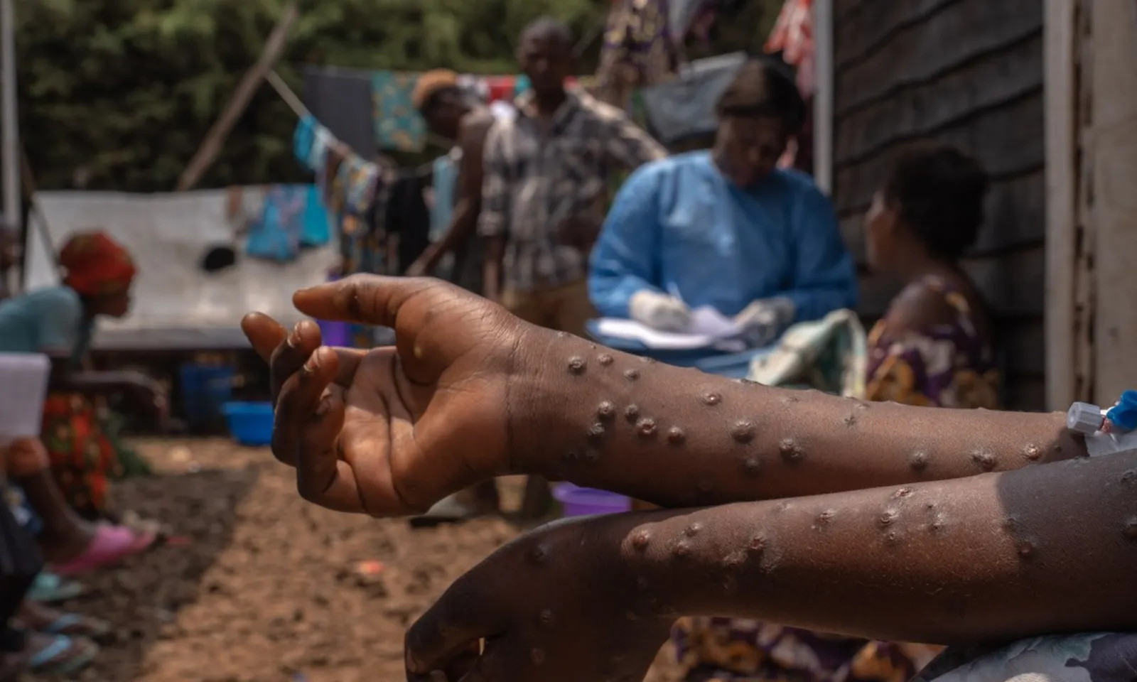 Số ca tử vong do bệnh mpox ở Uganda tăng lên 31 