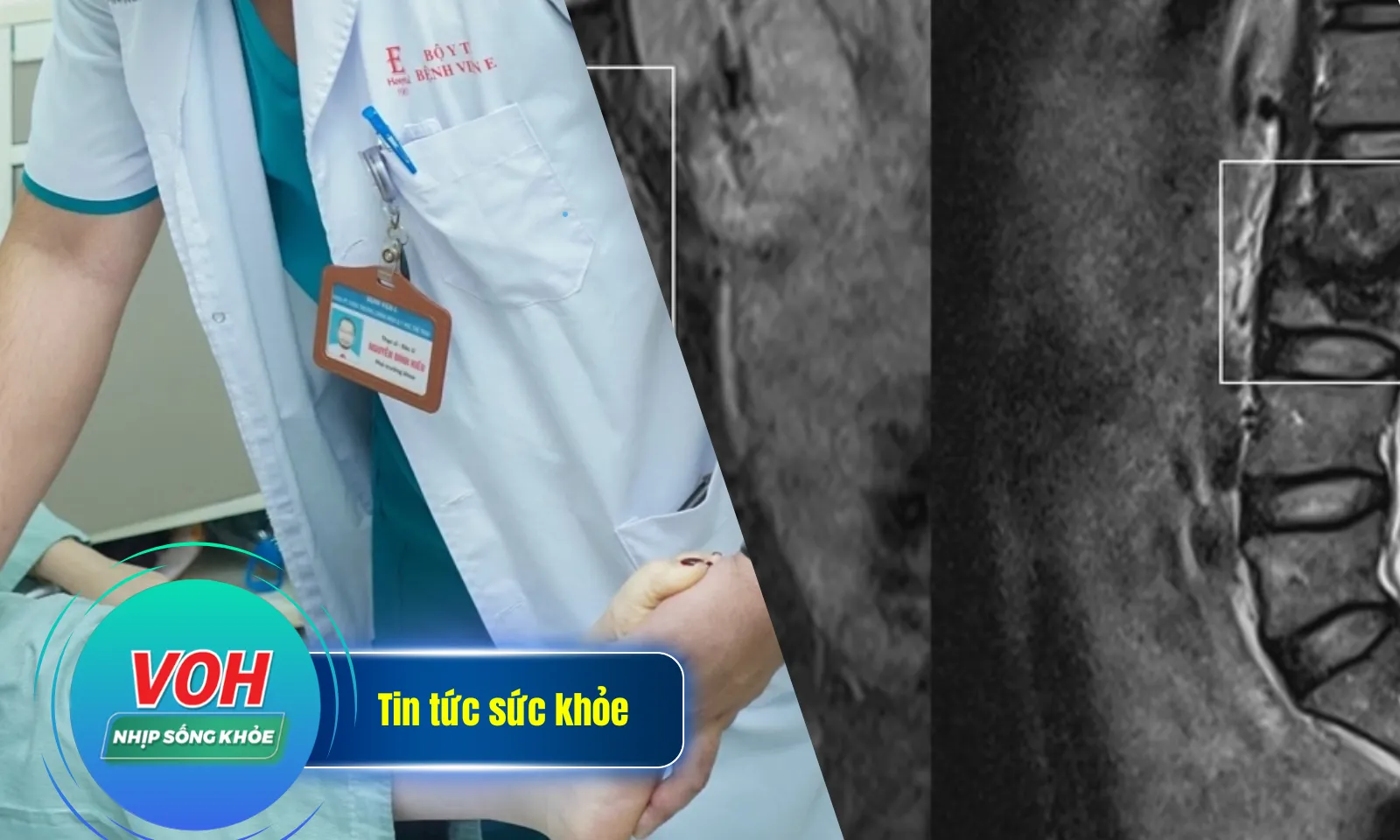 Nhịp sống khỏe 20/3: Cô gái mắc chứng xương hóa đá | Đau thắt lưng - phát hiện lao đốt sống