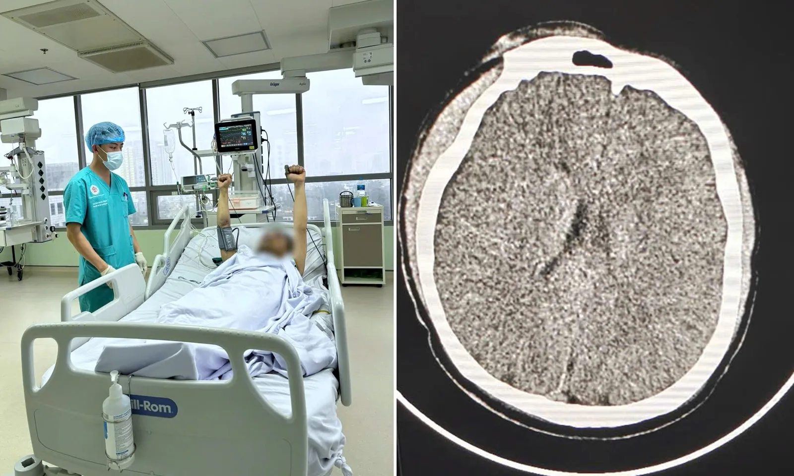 Cứu sống nam thanh niên phù não lan tỏa sau khi treo cổ tự tử