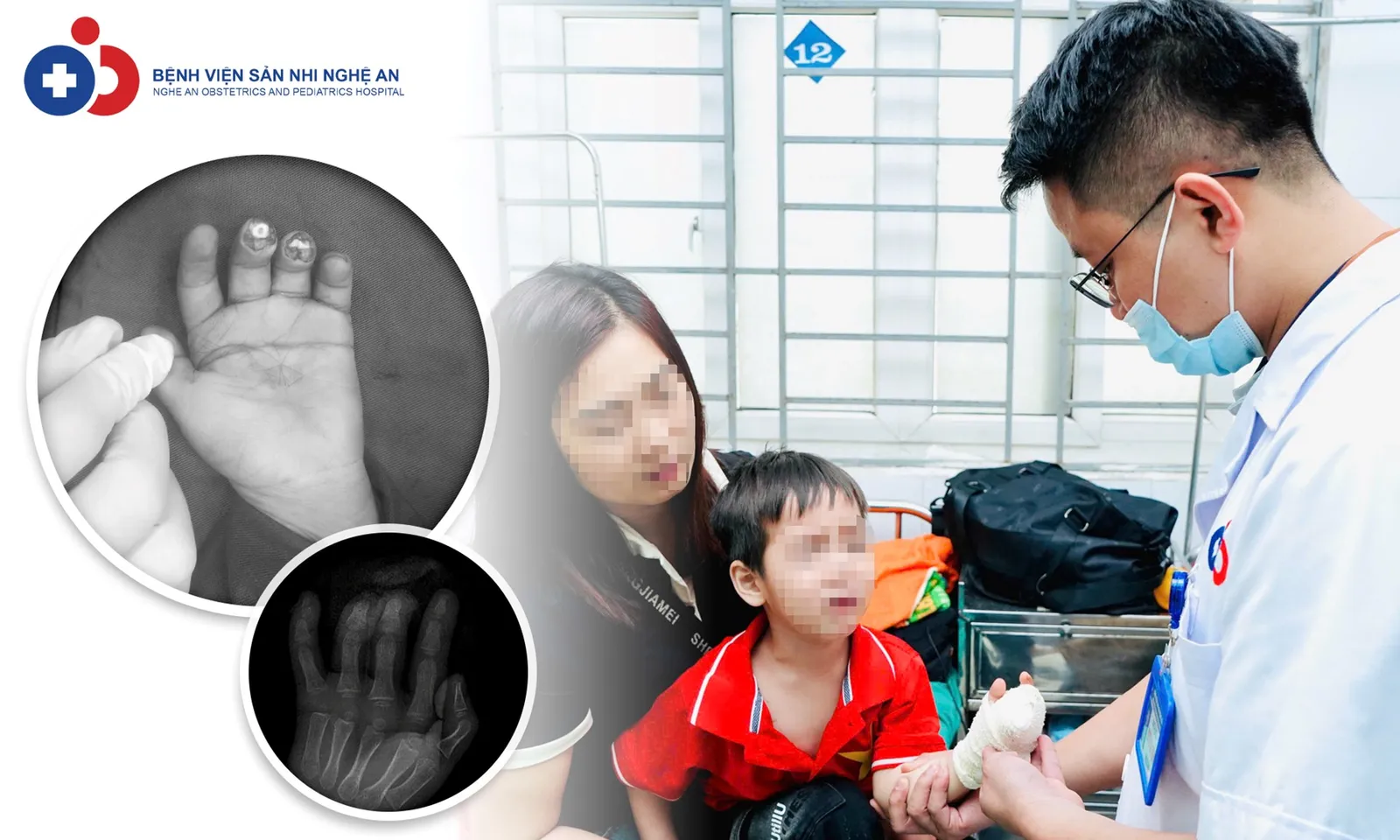 Bé trai 4 tuổi đứt lìa nhiều đốt ngón tay vì nghịch dao