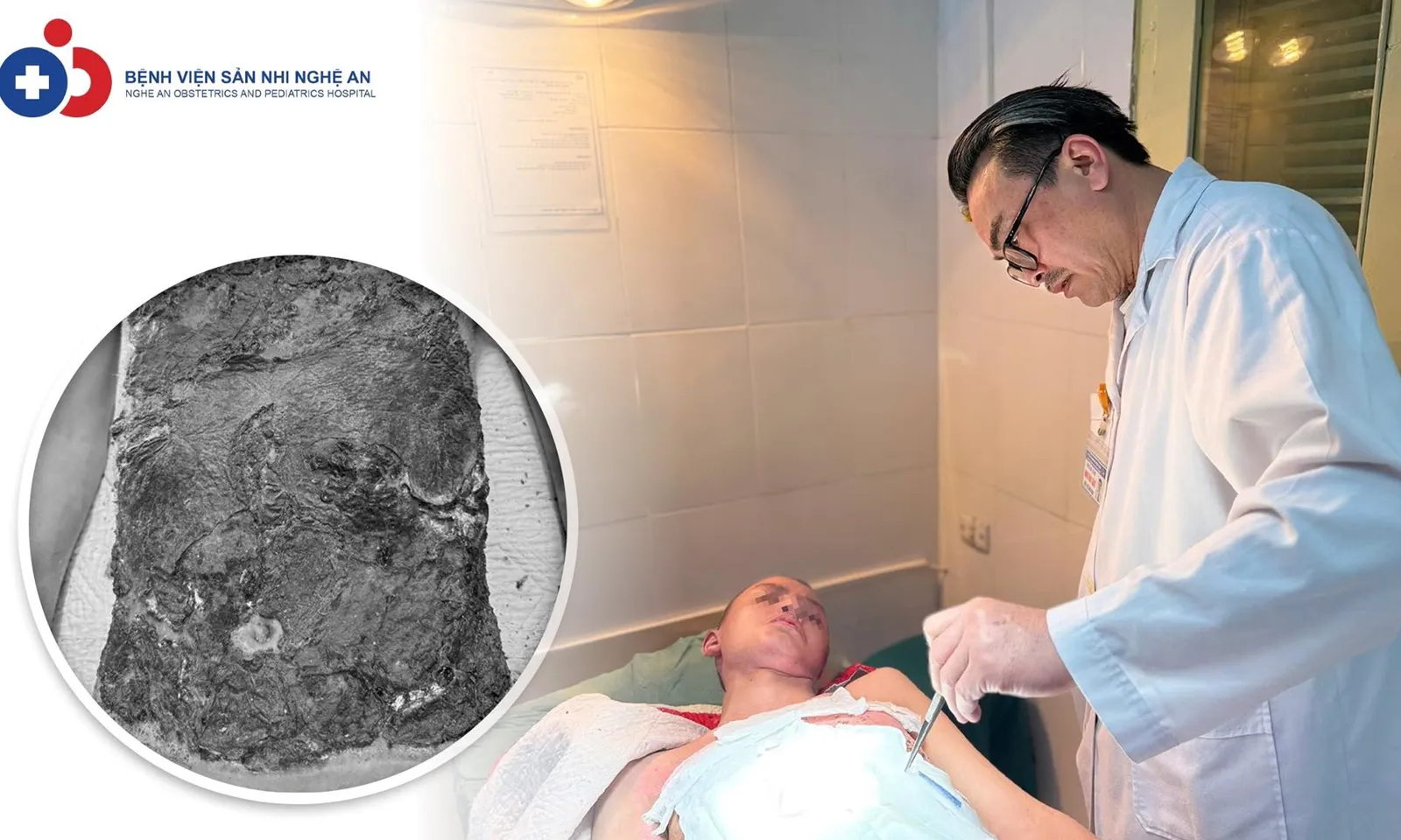 Bé trai 14 tuổi bị nhiễm trùng nặng do điều trị bỏng cồn bằng thuốc nam