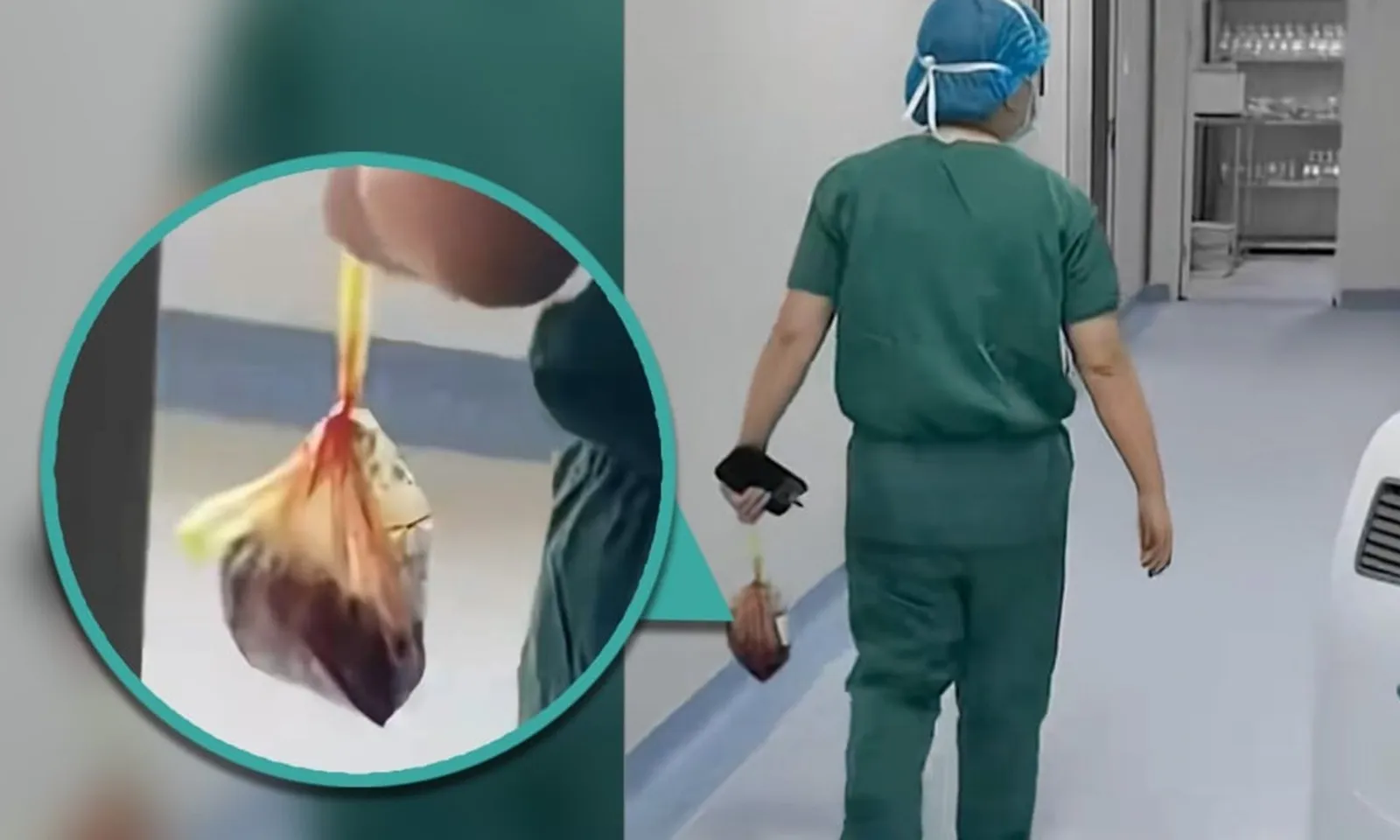 Bác sĩ bị sa thải vì trộm nhau thai của các sản phụ mới sinh để bán