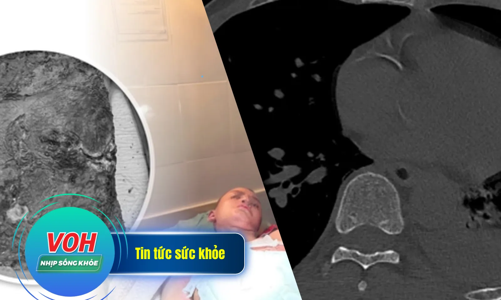 Nhịp sống khỏe 2/4: Nhiễm trùng do điều trị bỏng bằng thuốc nam | Suýt mất mạng vì nghĩ xây xước nhẹ
