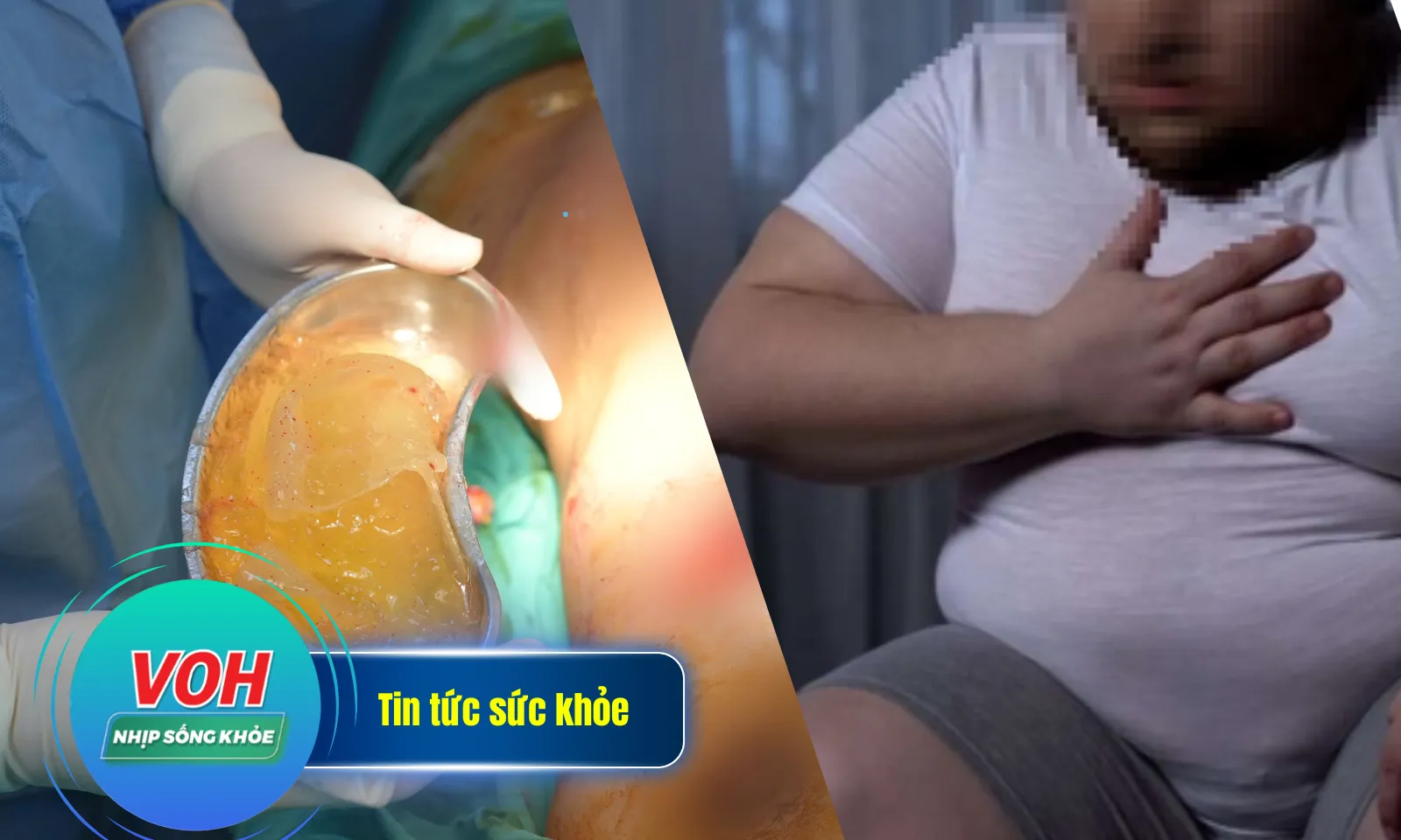 Nhịp sống khỏe 4/4: Vỡ túi nâng ngực khi đang mang thai | Ngừng thở khi ngủ vì quá béo 175 kg 