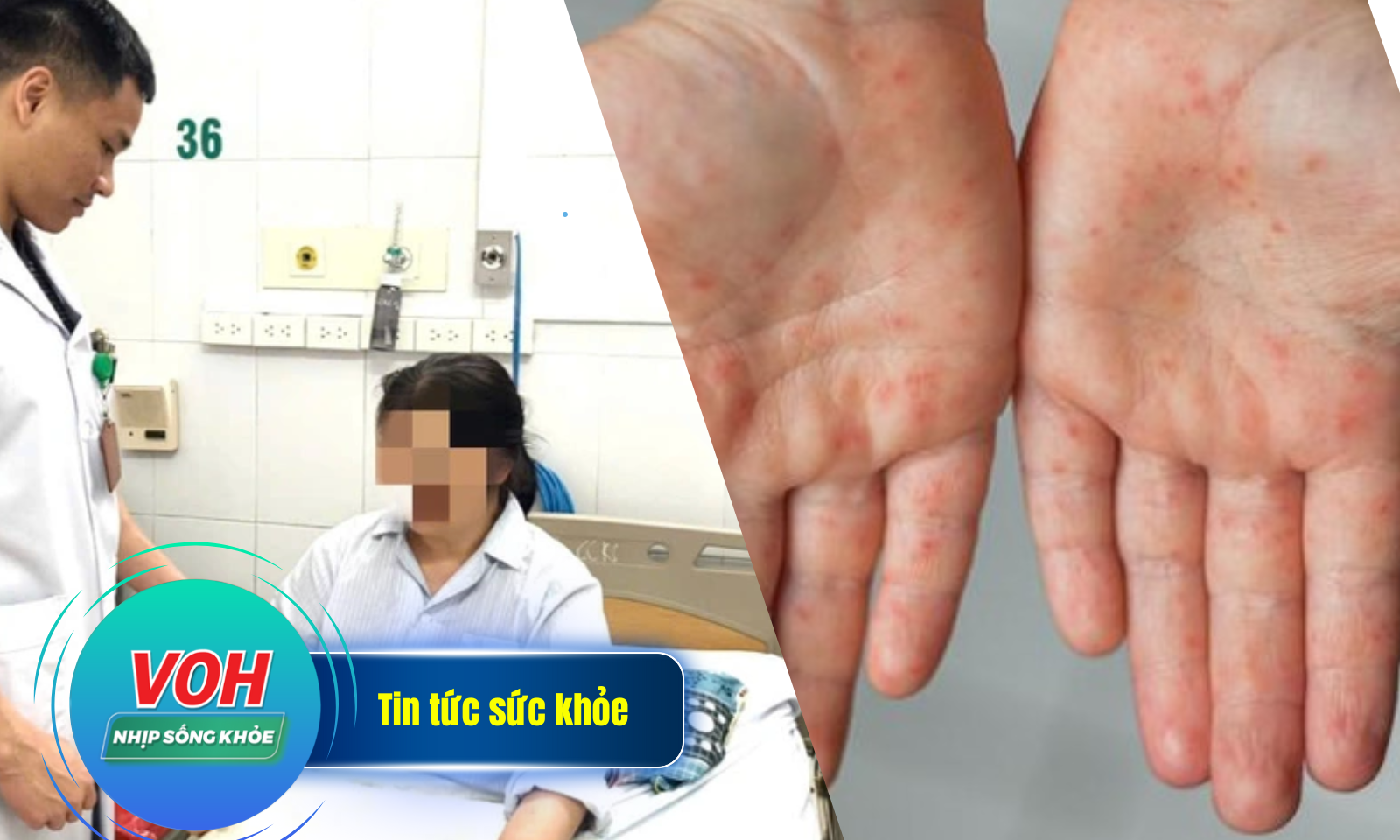 Nhịp sống khỏe 22/4: Bệnh tay chân miệng tăng mạnh | Phát hiện ung thư hiếm sau lần mổ tiết niệu