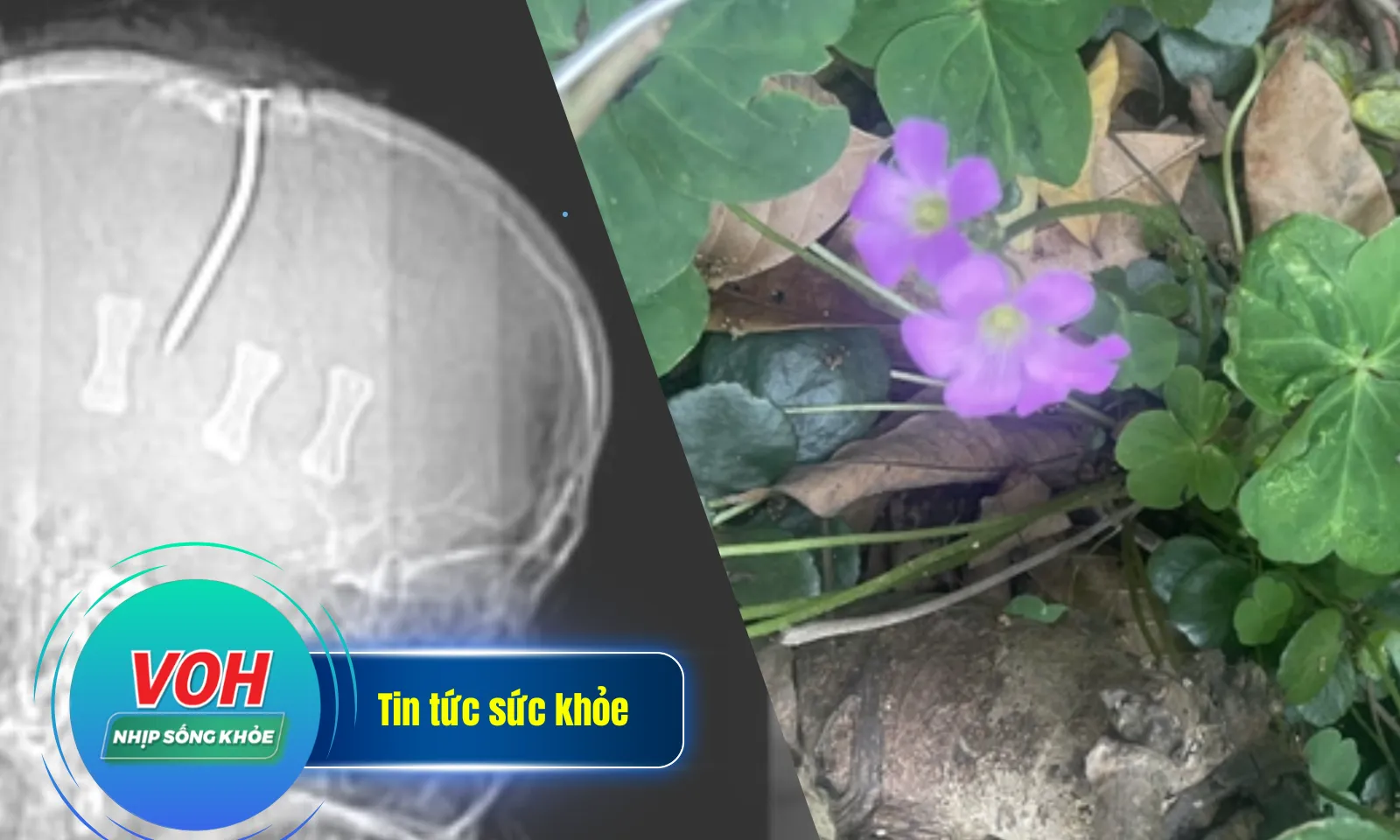 Nhịp sống khỏe 23/4: Suy thận cấp vì cây me đất hoa đỏ | Phát hiện đinh xuyên hộp sọ vì đau đầu