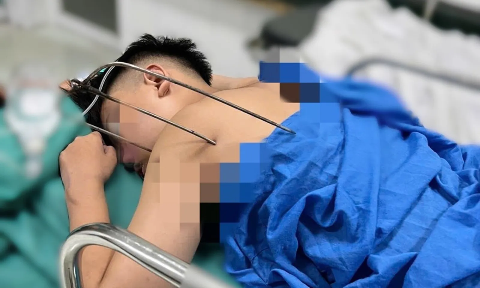 Chàng trai 17 tuổi bị đinh ba tự chế xuyên thấu tim