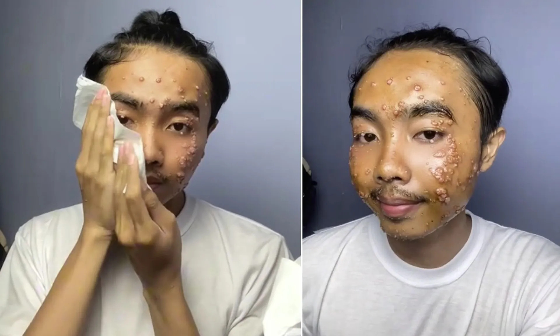 benh-ngoai-da-300425-1