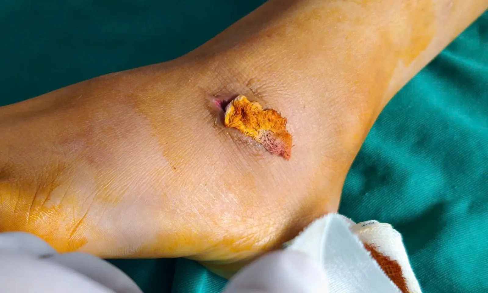 Bé gái nguy kịch vì mắc uốn ván sau khi bị thanh gỗ mục đâm vào bàn chân