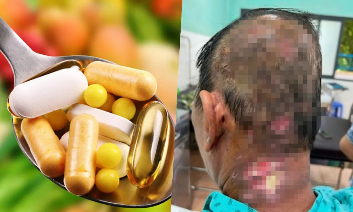 Điểm tin chiều 6/5: Xử lý nghiêm quảng cáo TPCN vi phạm | Nhiều ca bị zona thần kinh biến chứng 
