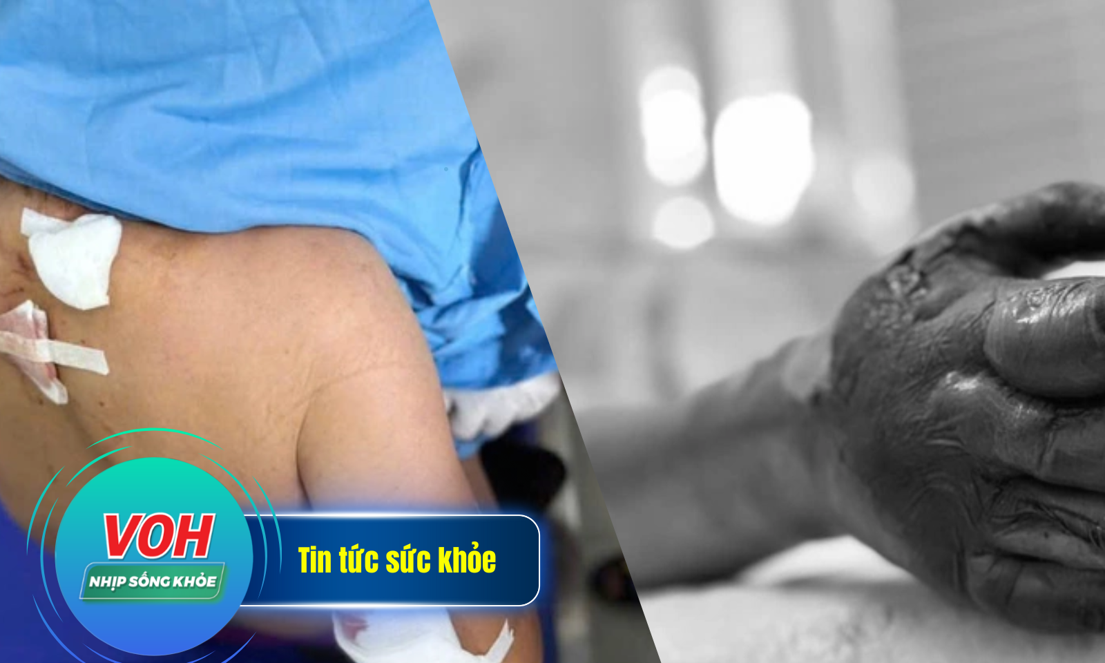 Nhịp sống khỏe 6/5: Cháy đen bàn tay do điện giật | Cụ bà 77 tuổi bị đàn chó cắn trọng thương