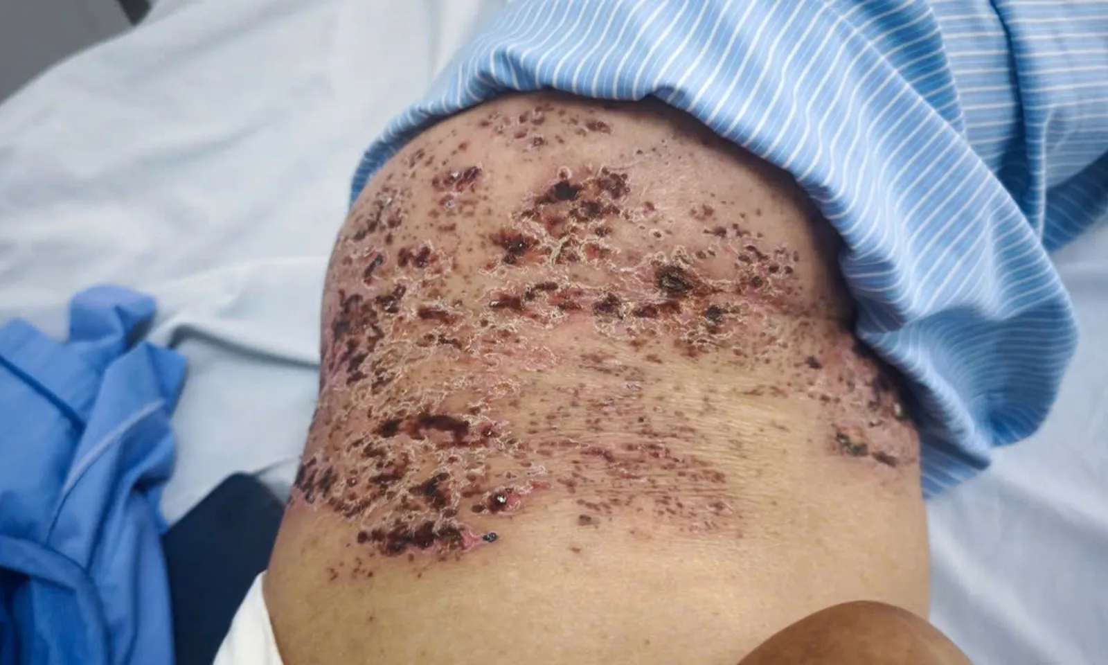 Nhiều người tổn thương da nghiêm trọng vì zona thần kinh