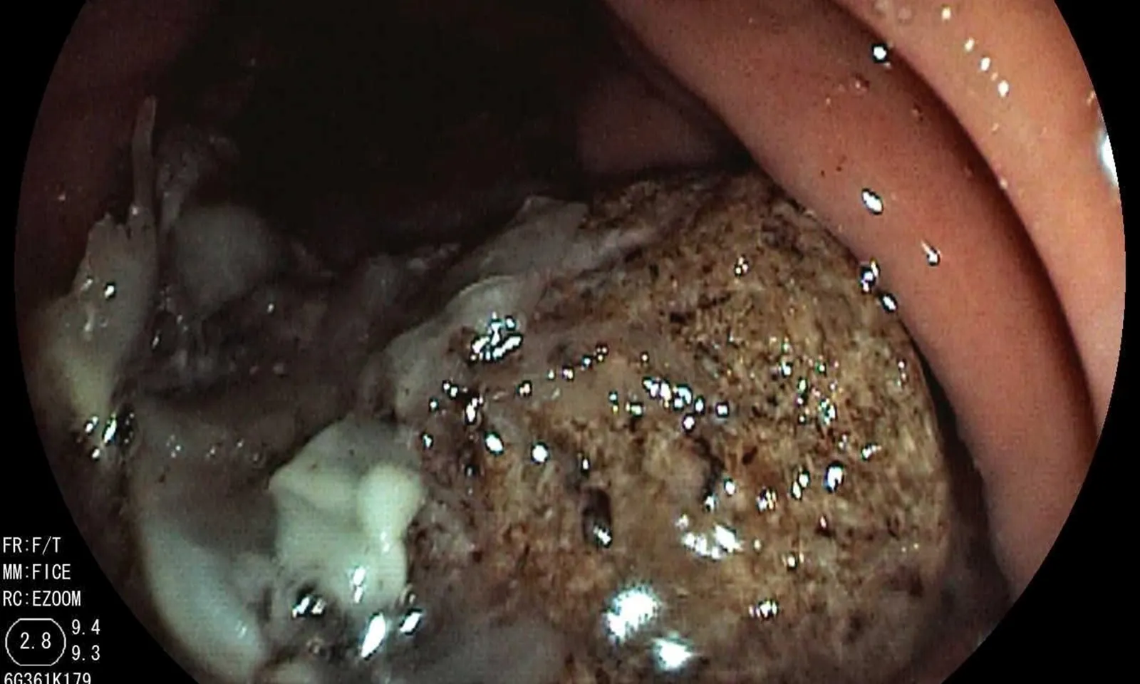 Lấy khối bã lớn trong dạ dày một cụ bà hay ăn trái cây có nhựa