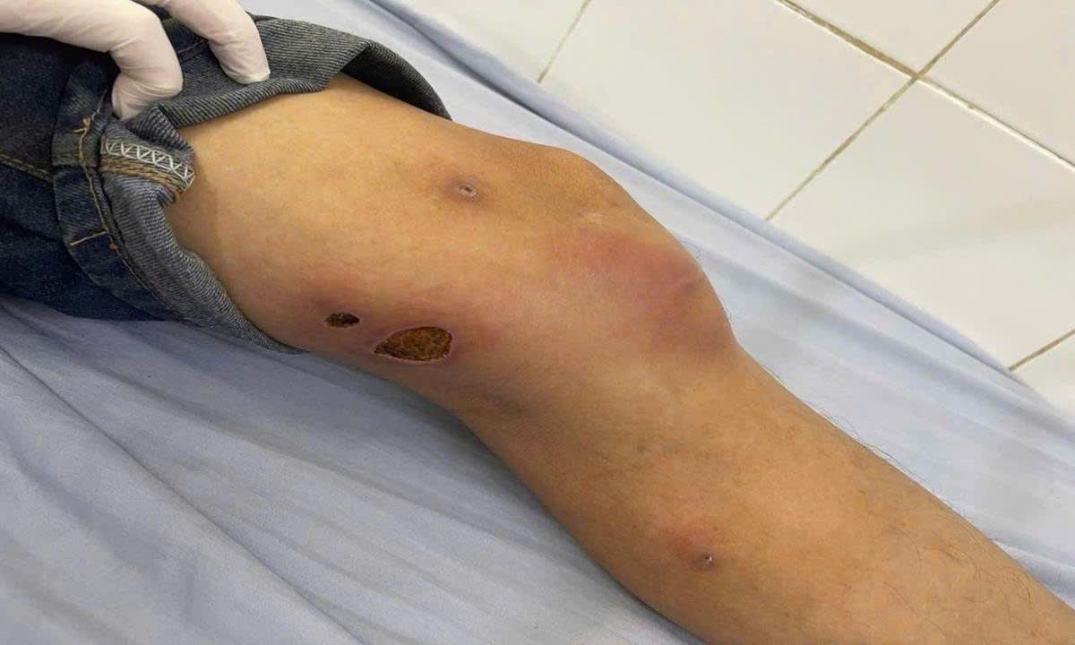 Cảnh báo bệnh giun rồng tái xuất tại Phú Thọ