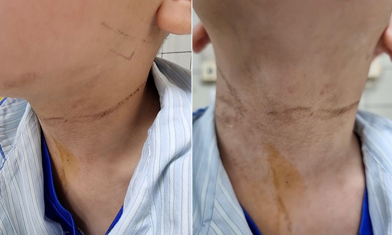 Bé trai 5 tuổi nghịch dây rút quần, tự quấn và treo cổ nguy kịch