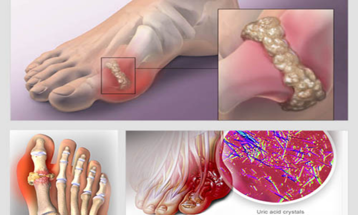 Bệnh gout ngày càng trẻ hóa: Lời cảnh báo từ lối sống hiện đại 