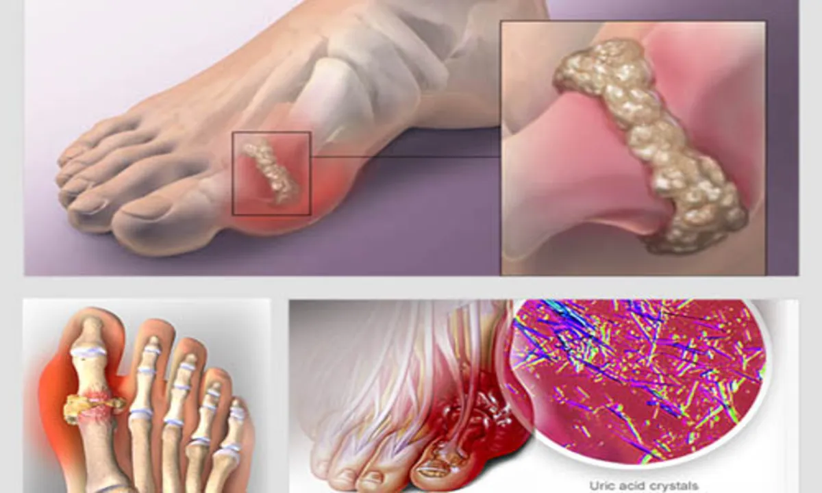 Bệnh gout ngày càng trẻ hóa: Lời cảnh báo từ lối sống hiện đại 