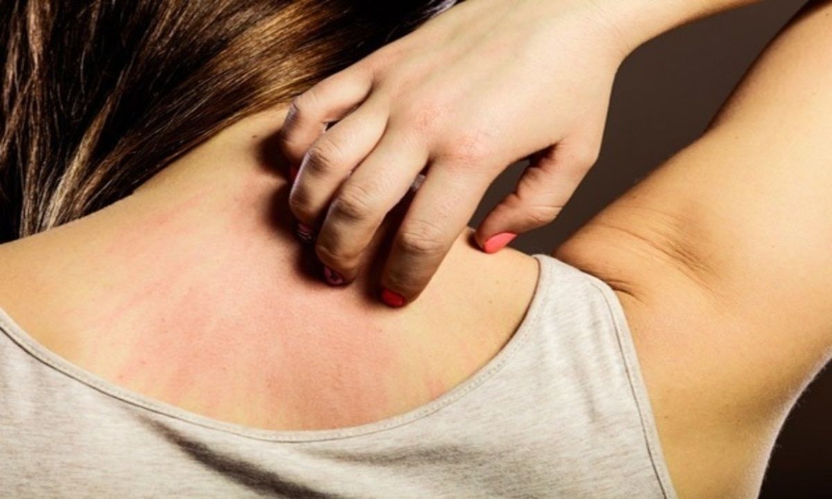 Những bệnh da liễu thường gặp trong giai đoạn giao mùa ẩm ướt