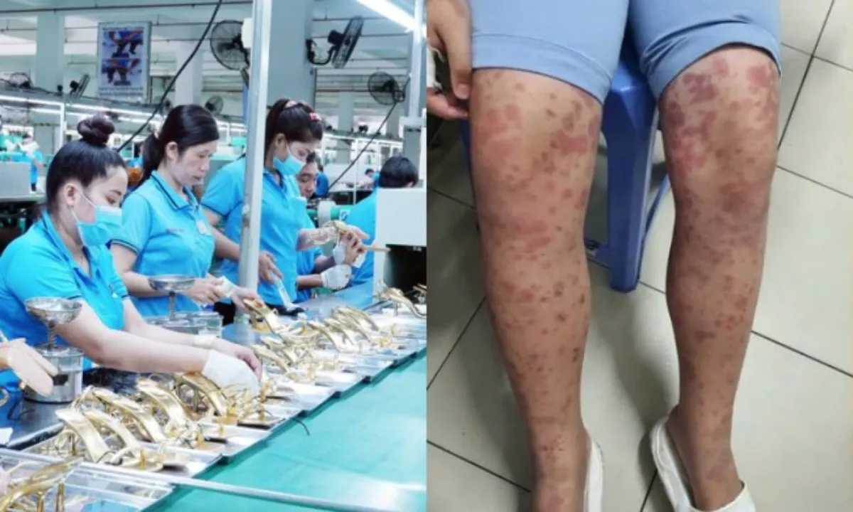 Điểm tin trưa 14/5: Hơn 10.000 việc làm chờ người lao động | Cảnh báo bệnh ban xuất huyết Schonlein 