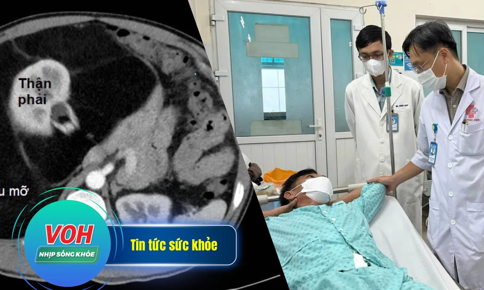 Phẫu thuật lấy trọn bướu mỡ khổng lồ nặng 8 kg trong bụng người bệnh