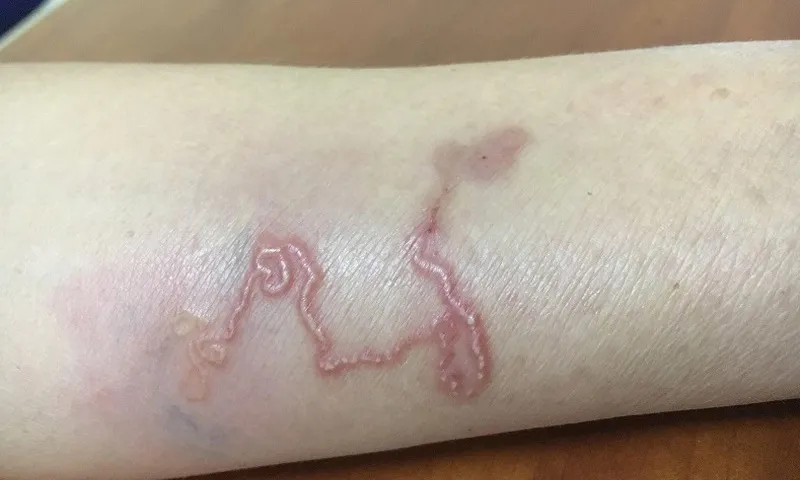 Phú Thọ ghi nhận ca mắc giun rồng thứ 26 tại Việt Nam