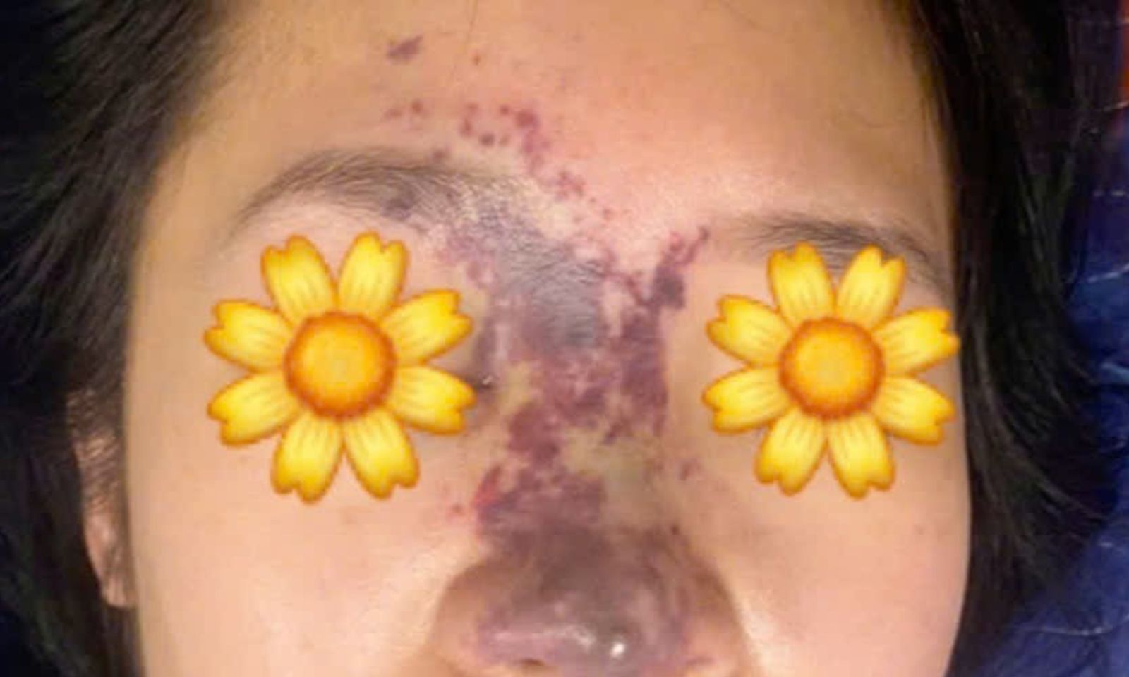 Cô gái bị cụt trụ mũi sau 6 lần chỉnh sửa mũi tại spa