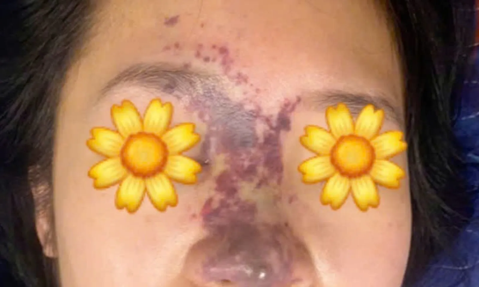 Cô gái bị cụt trụ mũi sau 6 lần chỉnh sửa mũi tại spa