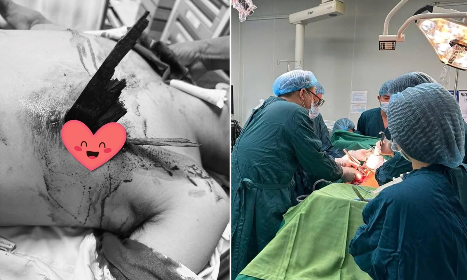 Cứu sống nam thanh niên bị thanh gỗ đâm xuyên ngực sau tai nạn xe máy