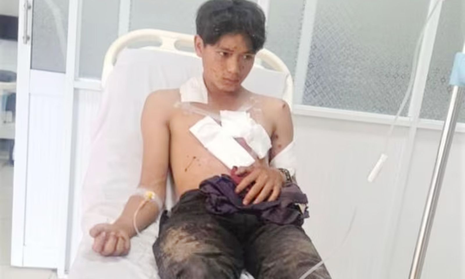 Nổ mìn tự chế khi đi đánh cá, 2 thiếu niên bị thương nặng 