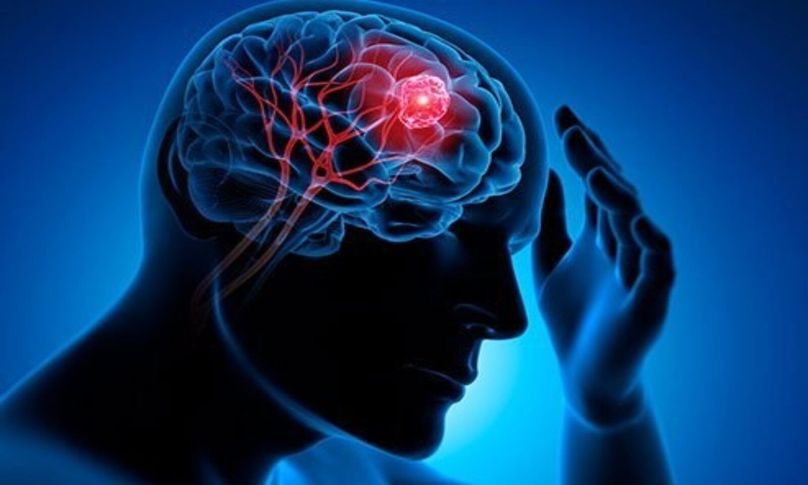 Các dấu hiệu cảnh báo u não