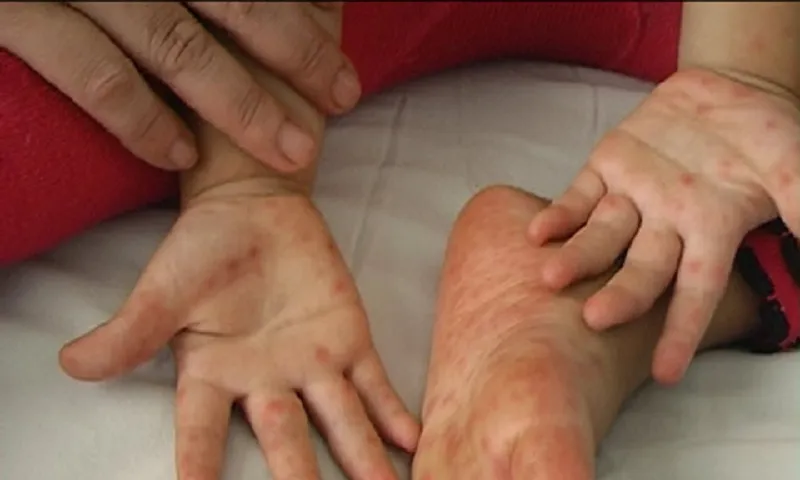 TPHCM: Số ca mắc tay chân miệng và sốt xuất huyết tăng