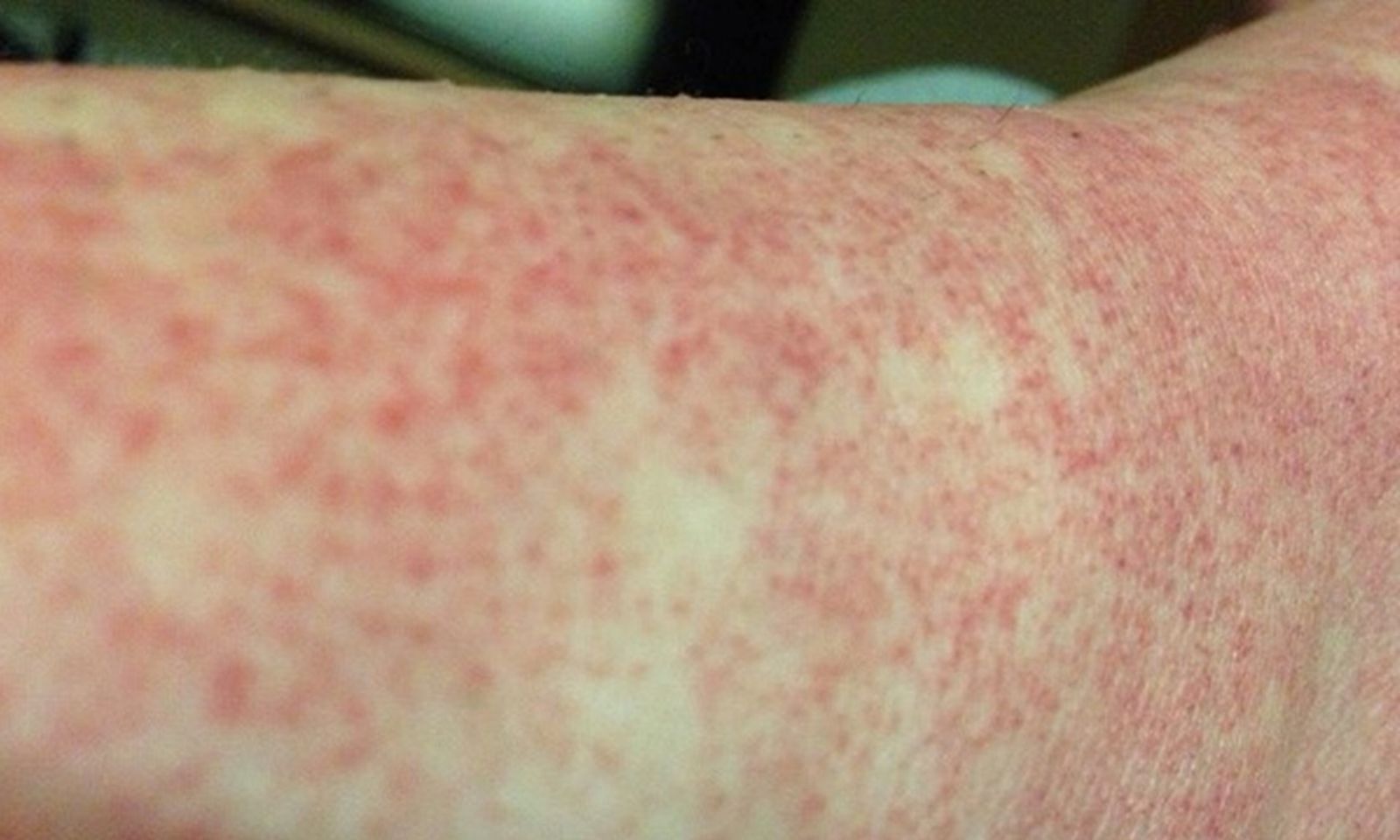 Cô gái 21 tuổi suýt mất mạng vì sốc sốt xuất huyết Dengue nặng