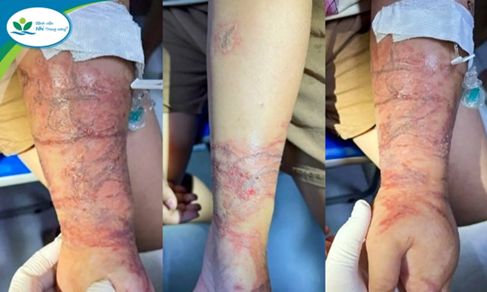 Bé gái bị phỏng rát 2 cánh tay do chạm vào sứa khi tắm biển