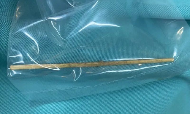 Bé trai 12 tuổi ở Bình Dương bị cây tăm đâm thủng tá tràng, phải mổ cấp cứu