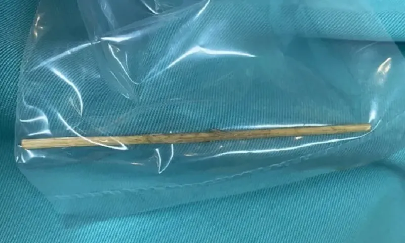 Bé trai 12 tuổi ở Bình Dương bị cây tăm đâm thủng tá tràng, phải mổ cấp cứu